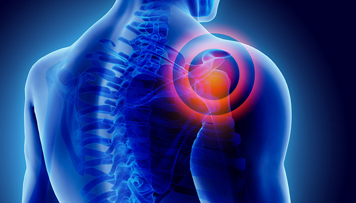 What to Expect After a Rotator Cuff Surgery